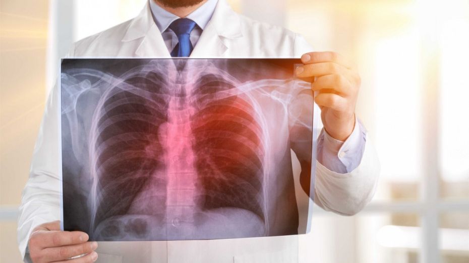 Webinář o tuberkulóze - ONLINE